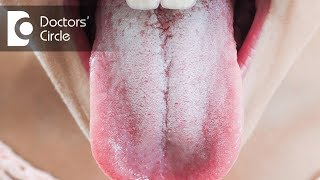 Is Oral thrush contagious? - Dr. Jayaprakash Ittigi