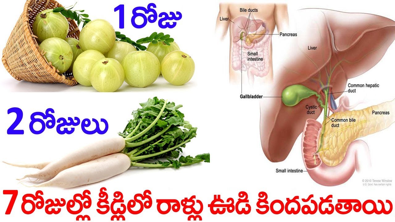 get rid of kidney stones with in 7 days | How to get rid of kidney stones - YouTube