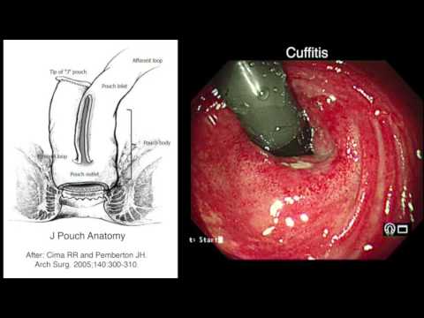 J POUCH CUFFITIS - YouTube ulcerative colitis diagram 