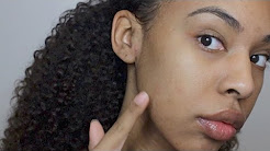 How to get Rid of Acne and Acne Scars Over Night with Aloe Vera and Tea Tree Oil!