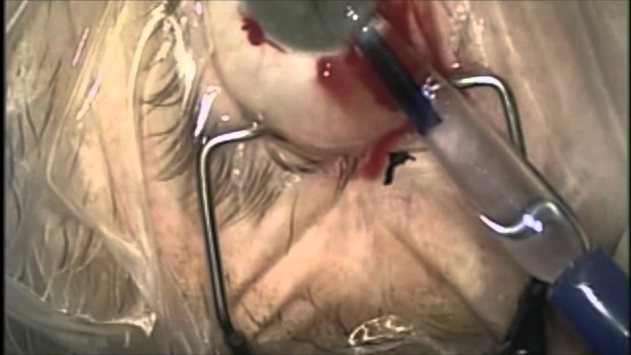 http://clinicaltrials.gov Descemets Membrane Endothelial Keratoplasty (DMEK)