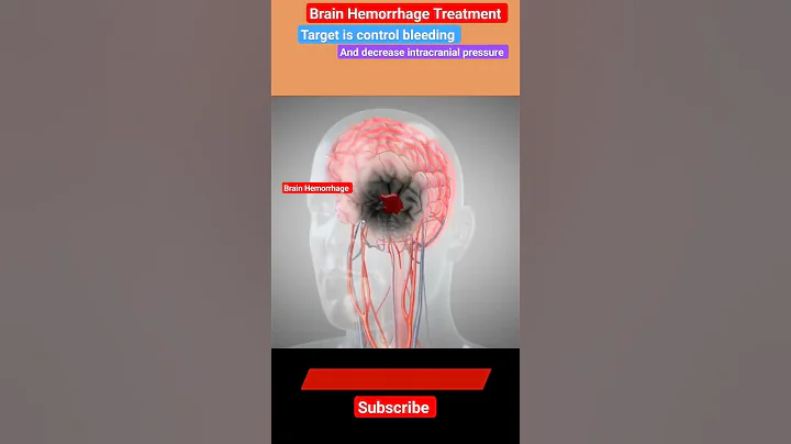 Brain Hemorrhage Treatment l Mannitol l Craniotomy #stroke  #shorts