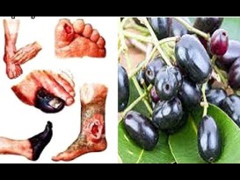 What is Diabetes? and it turns out that Duwet fruit is effective in treating diabetes mellitus