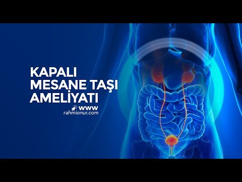 Lazerle Kapalı Mesane Taşı Ameliyatı - Prof. Dr. Rahmi Onur