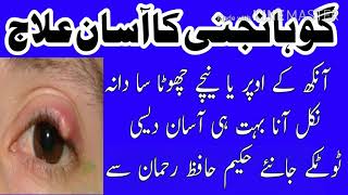 Gohanjni ka ilaj in urdu Hindi || treatment of Eye pimple ||گوہانجنی کا آسان علاج || by hakeem hafiz