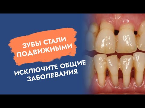 Зубы стали подвижными. Исключите общие заболевания!