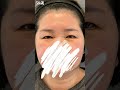 前額リフトでつるんとした額🌟