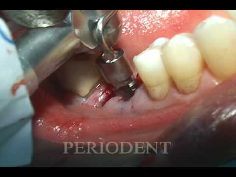 Molar Extraction and Immediate Implant Placement