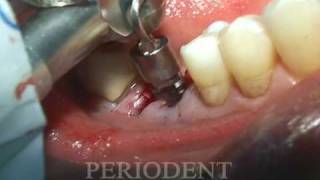 Molar Extraction and Immediate Implant Placement(Endodontic Failure,Extraction of Molar with separation of three Roots first, Immediate Implant Placement with Autograft and Xenograft, Notice the Gain Height of ..., 2009-01-15T05:37:32.000Z)