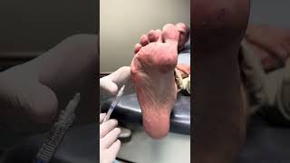 Radiesse dermal filler injections for pain on the ball of the foot by Timonium Foot and Ankle Center 963 views 7 months ago 1 minute, 29 seconds