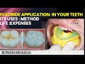 जानें कैसे लगाते है FLUORIDE दांतो पर -FLUORIDE APPL. ON YOUR TEETH,ITS USES,METHOD,LIFE,EXPENSES