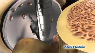 FlexMetric® Acetabular Drill