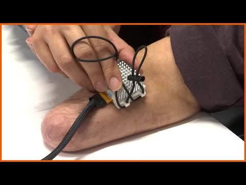 Bionic tech gives thermosensation to amputees