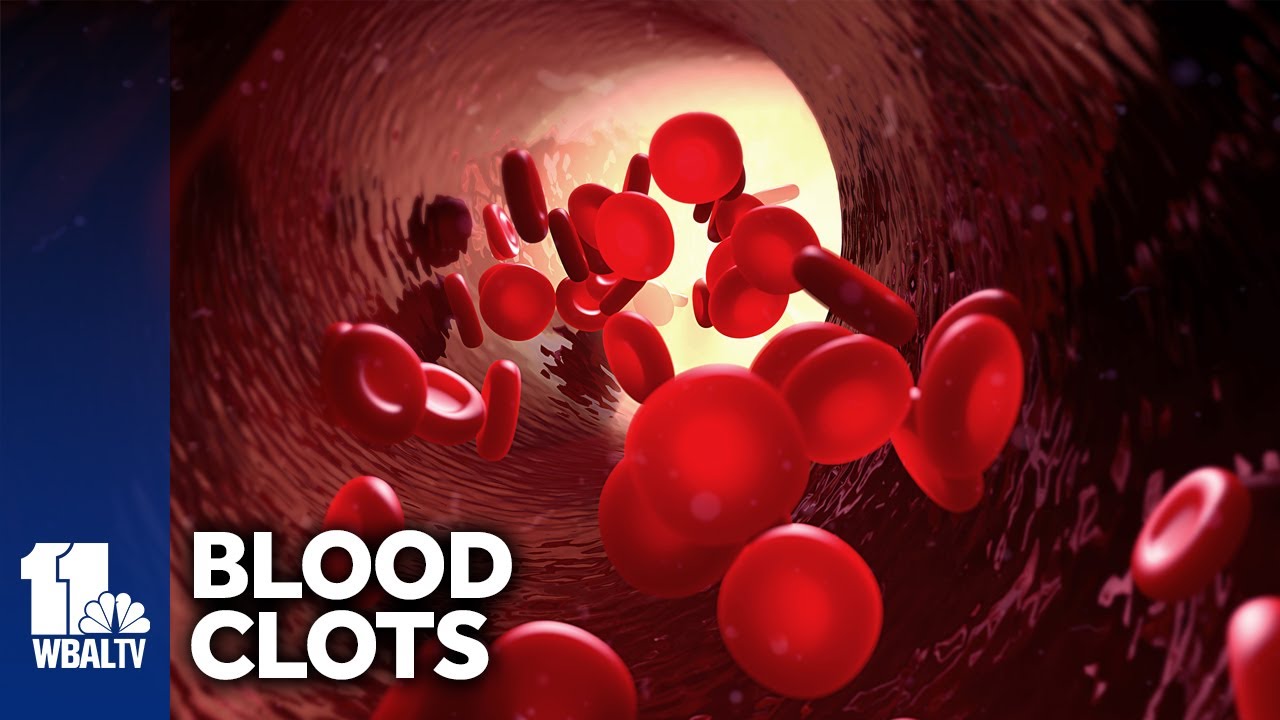 Women at higher risk for blood clots YouTube