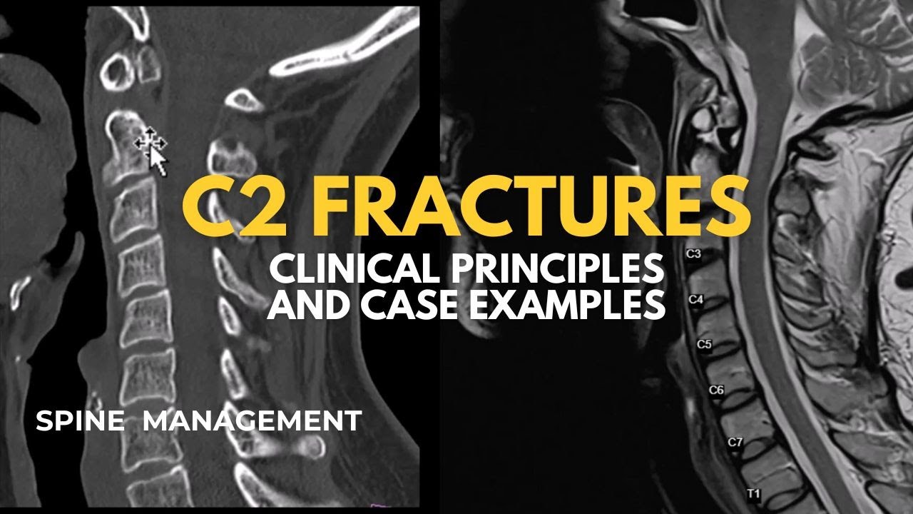 C2 Fractures: Clinical Principles and Case Examples - YouTube