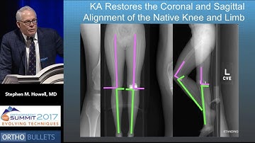 Pro: Kinematic Alignment Is All That Matters! - Stephen M. Howell, MD