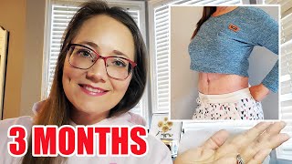 3 Month Tummy Tuck Scar Update | Before and After Pictures #plasticsurgery