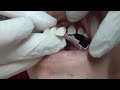 تركيبات الاسنان المتحركه (مضطر اعملها لهذا السبب)😞🛑بدون برد الاسنان// دكتور رامي محجوب