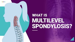 What is Multilevel Spondylosis?