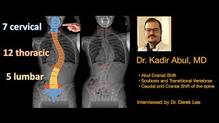 Dr. Kadir Abul, MD, on Scoliosis Transitional Vertebrae and Abul Cranial Shift with Dr. Derek Lee