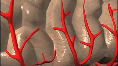 Stroke - secondary to cardiogenic embolism