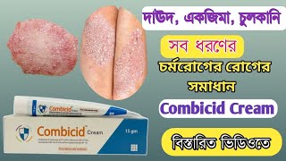 দাদ ও চুলকানি দূর করার উপায় | Combicid Cream | Fungal Infection | Tinea Corporis, Ringworm