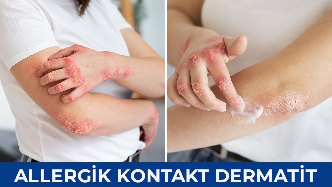 Allergik kontakt dermatit - Gülşən Əzizova (Dermatoveneroloq ...