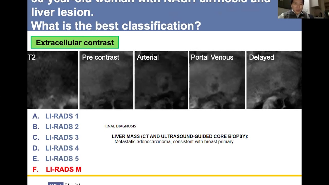 Casebased Eovist tutorial! (Victor Sai) YouTube