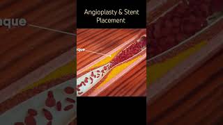Coronary Artery Disease Angioplasty & Stent Placement Part 1