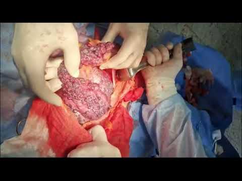 An unusual cause of lower intestinal bleeding Незвичайна причина нижньої кишкової кровотечі