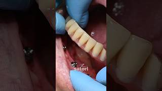 All on 4 - временный протез на беззубую челюсть  #имплантациязубов #allon4dentalimplants