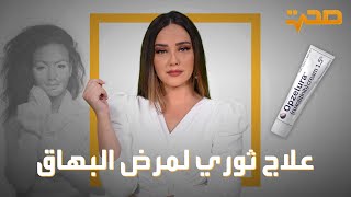 العربية صحة | علاج ثوري لمرض البهاق