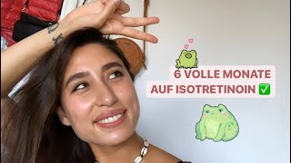 Aknenormin Therapie Vollständig 6 Monate Auf Isotretinoin Meine Haut Ist Super