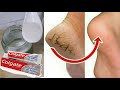COMO ACABAR RACHADURAS NOS Pés CALOS E DEIXAR LISINHOS E MACIOS USANO A PASTA DE DENTE