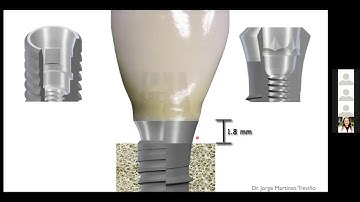 ‘Dental implants in the esthetic zone...The challenge!!’
