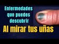 ENFERMEDADES QUE PUEDES DESCUBRIR AL MIRAR TUS UÑAS