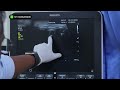 Tactra Implant Healing Update | Day 3 Scan Report