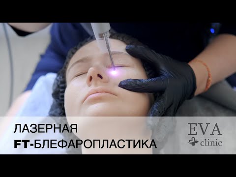 Безоперационная лазерная FT - блефаропластика