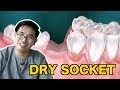 Dry Socket (Dollah Khair)