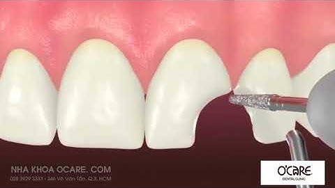 Giới thiệu phương pháp trám răng sứt mẻ