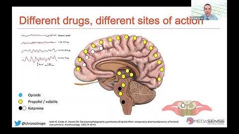 Integrating NOL and processed EEG to Optimise Anti-Nociception