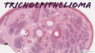Trichoepithelioma 101
