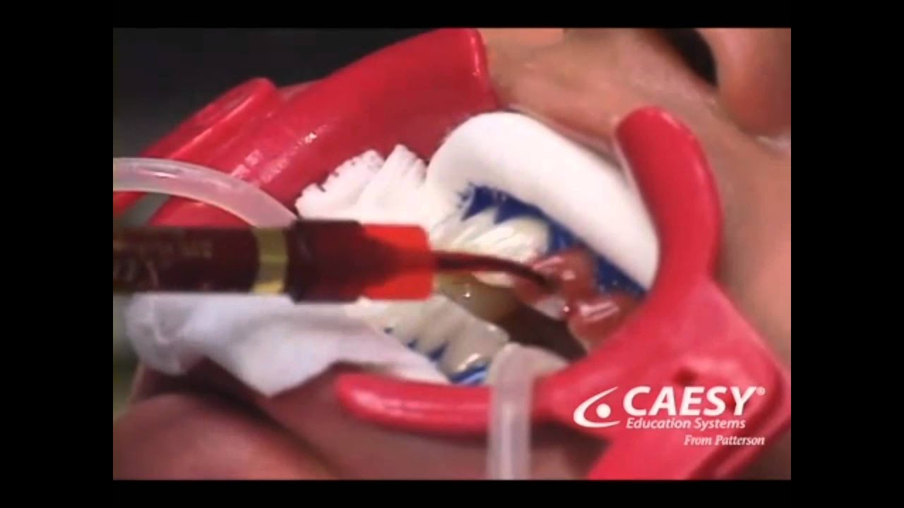 In Office Teeth Whitening 2 YouTube In Office Teeth Whitening 2 YouTube