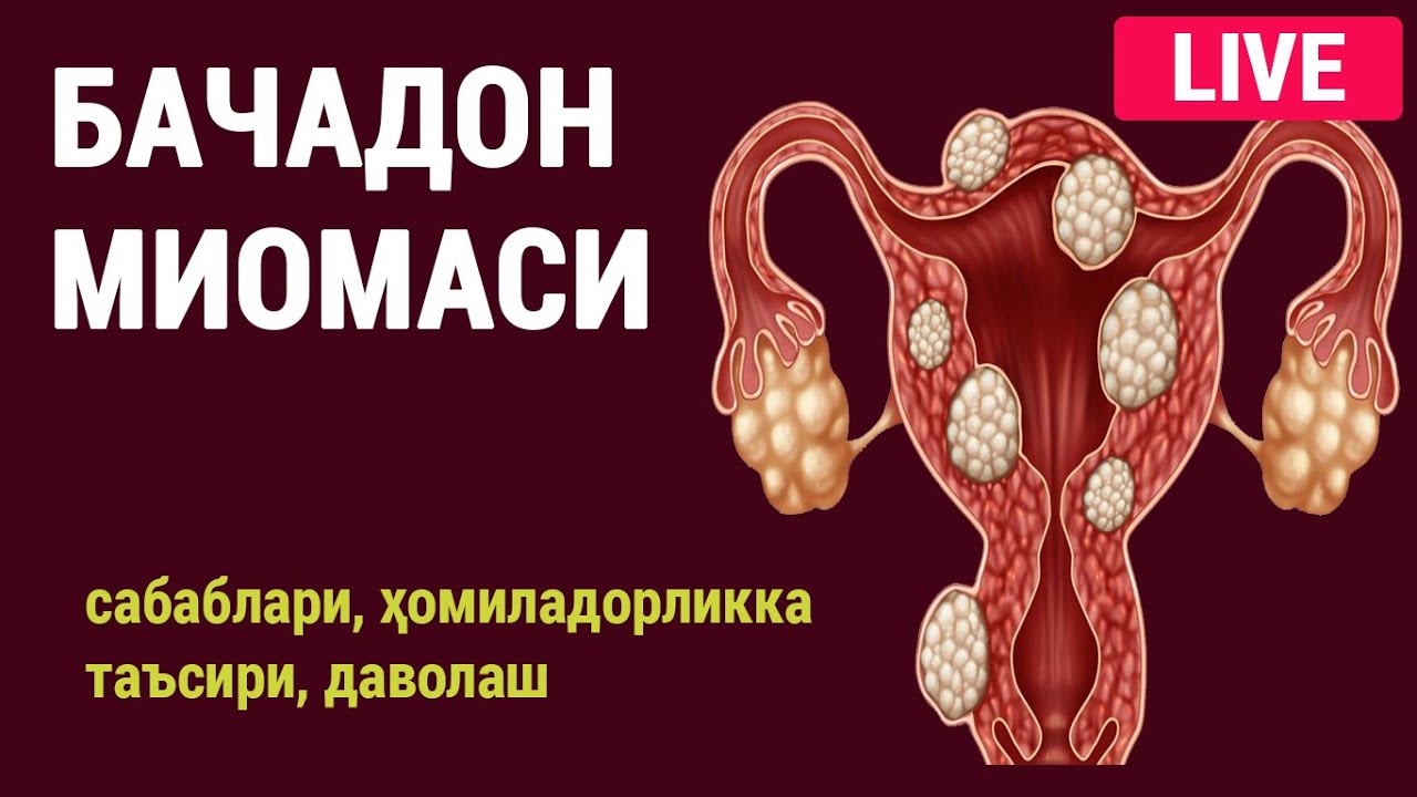 Бачадон миомаси. Сабаблари, ҳомиладорликка таъсири ва даволаш.