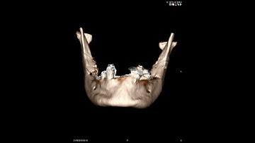 Mandibular Implants CT Vol rendering