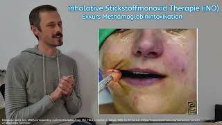 Stickstoffmonoxid-Inhalation - iNO Therapie