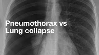 Pneumothorax vs Lung Collapse