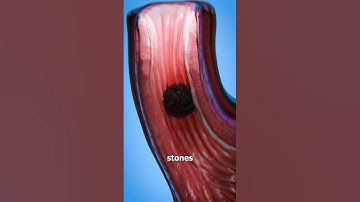 Why Hair Stones Were Used As Medicine 🤢