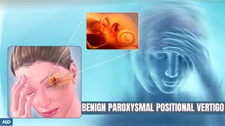 Benign Paroxysmal Positional Vertigo: What You Need To Know