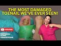 Damaged Thick Toenail Removal | MissFootFixer